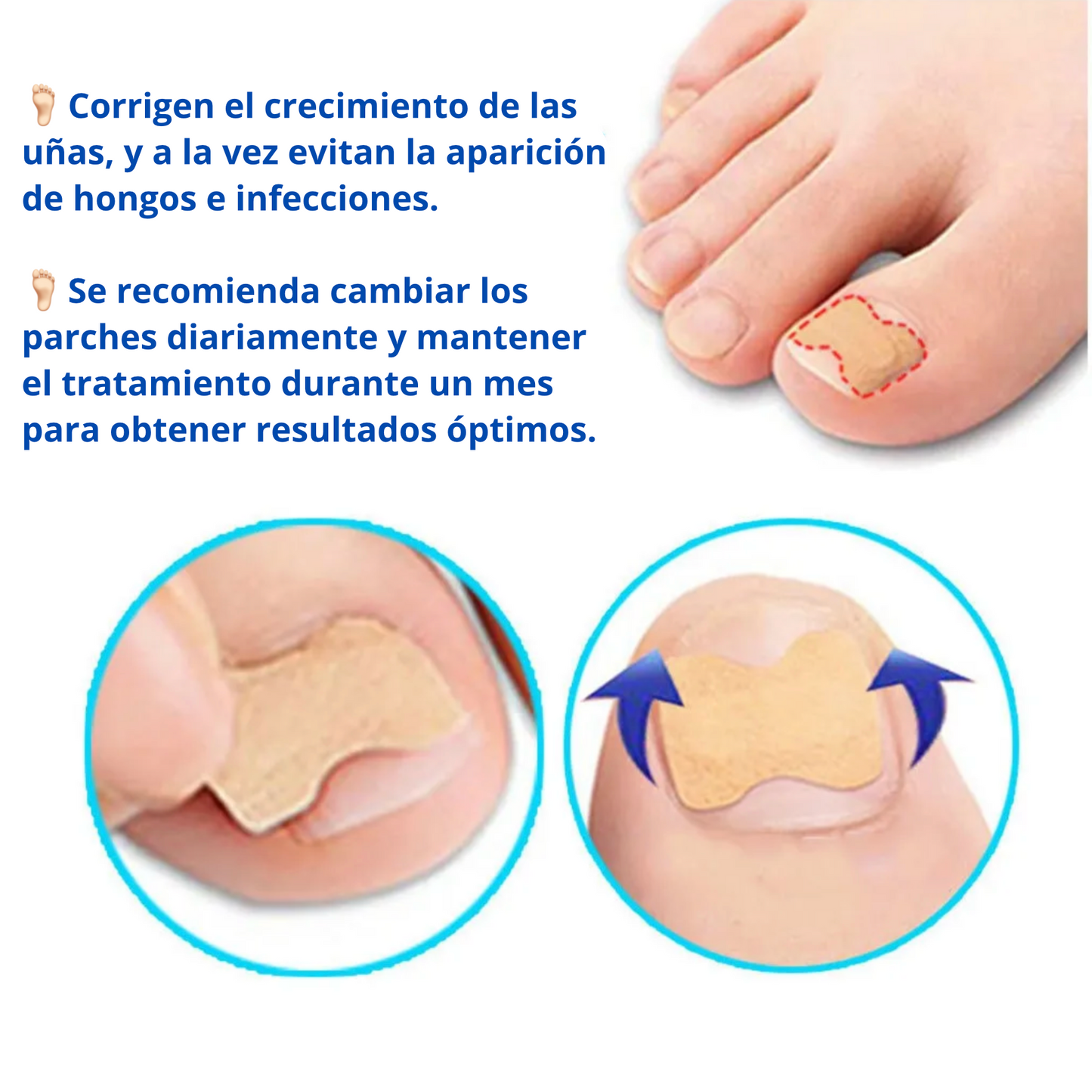 ¡Últimas Unidades! Free Nail™, Parche corrector uñas encarnadas y con hongos